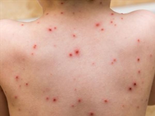 Free chickenpox vaccination on the NHS from January