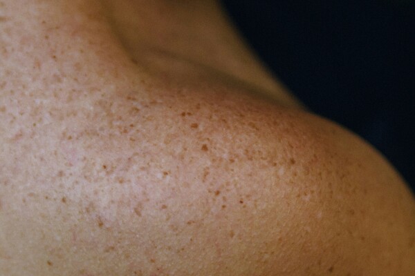 Image for article titled Melanoma